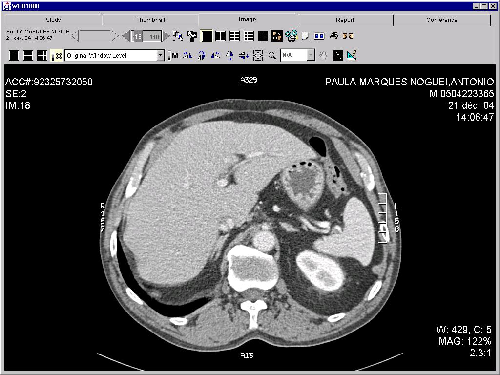 Bilan d extension M: Scanner abdominal (surrénales, foie) Scanner ou IRM cérébrale TEP Bilan d extension M: recommandations