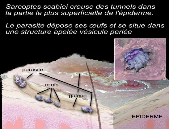 La gale Infection cutanée très contagieuse Due à un parasite strictement humain : Sarcoptes scabiei hominis