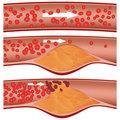 Thrombose vasculaire circulation normale plaque d athérome thrombose La thrombose correspond à la formation d un caillot qui obstrue le