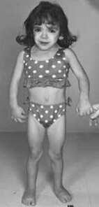 D autres anomalies chromosomiques Monosomie X 1/800 Syndrome de Turner Homme Femme stérile de petite (testicules taille, stérile atrophiés)