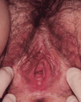 Cas clinique n 1: examen clinique Pilosité pubienne Elasticité muqueuse vulvo-vaginale Lubrification