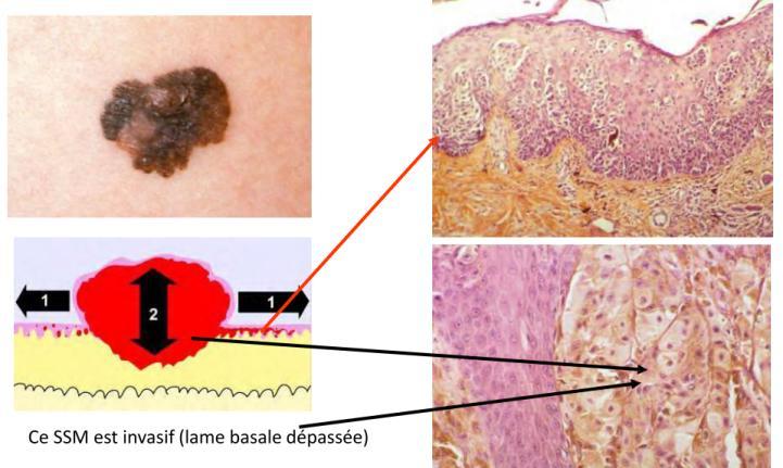 La couche épineuse est envahie par des mélanocytes tumoraux. Dans la papille dermique on a une réaction inflammatoire.