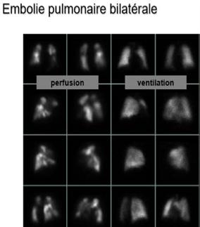 pulmonaires correspondant à des segments non perfusés mais l image de ventilation pulmonaire reste normale avec une répartition du traceur normale et homogène.