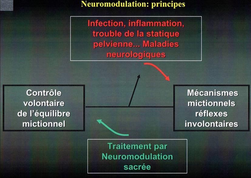 Principe de la Neuromodulation Sacrée S3 Mécanisme d action Traite les désordres chroniques du cycle mictionnel L'envoi