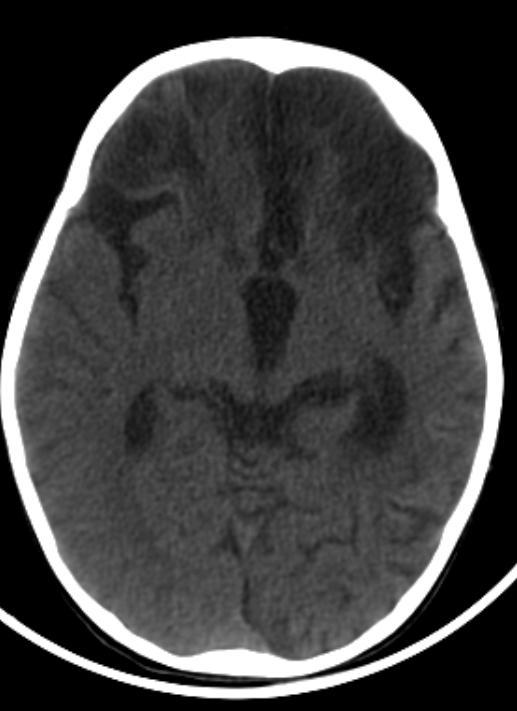 TDM : plages hypodenses cortico sous corticales frontales bilat