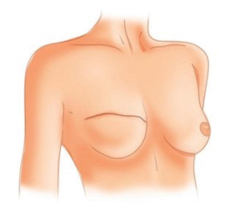 RECONSTRUCTION MAMMAIRE IMMÉDIATE Dans certains cas, et en particulier quand il n y a pas d indication de radiothérapie sur la peau du sein après mammectomie, il est possible de réaliser une